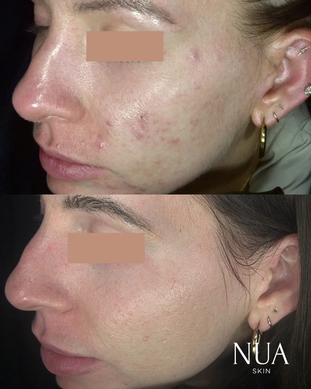 Before and after skin treatment — Blotchy Patches Smoothed