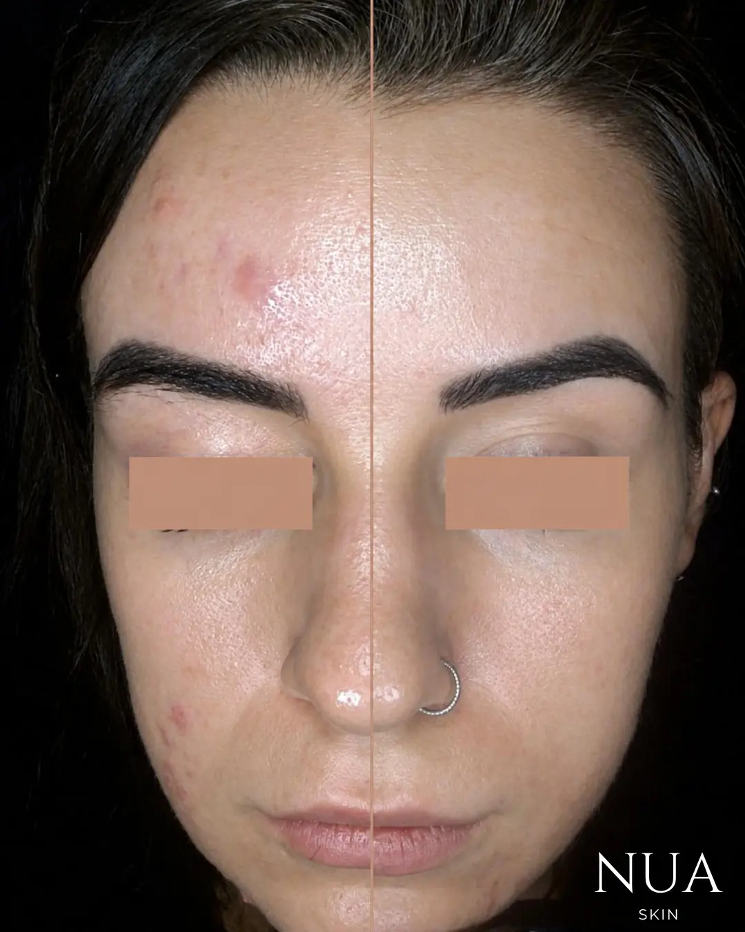 Before and after skin treatment — Overall Clarity Achieved