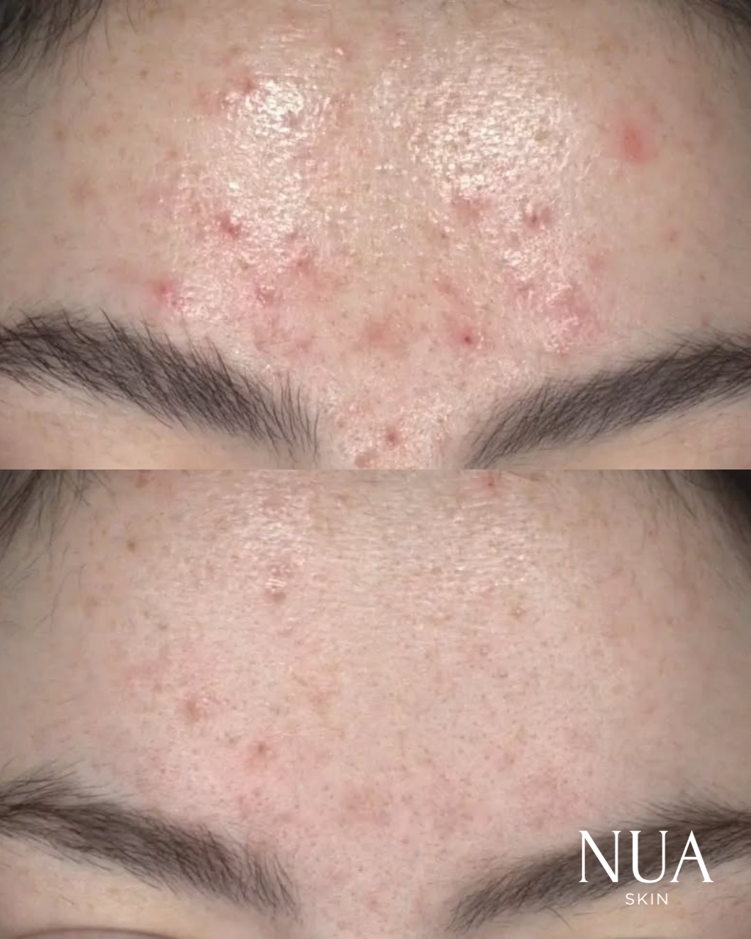 Before and after skin treatment — Congestion & Marks Cleared