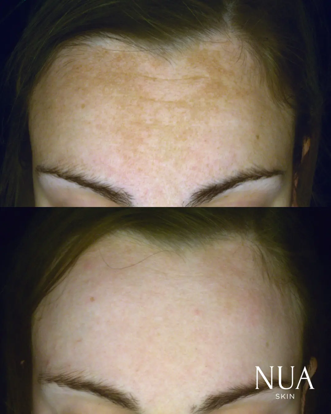 Before and after skin treatment — Freckling & Sun Spots Lightened