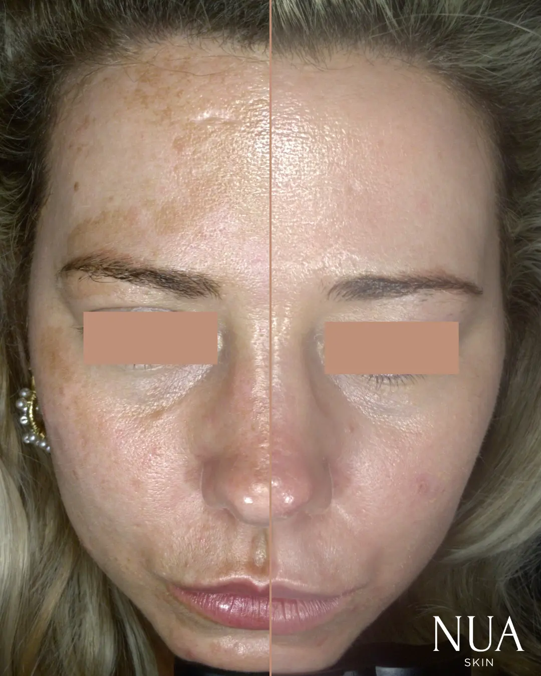 Before and after skin treatment — Sun Damage Cleared
