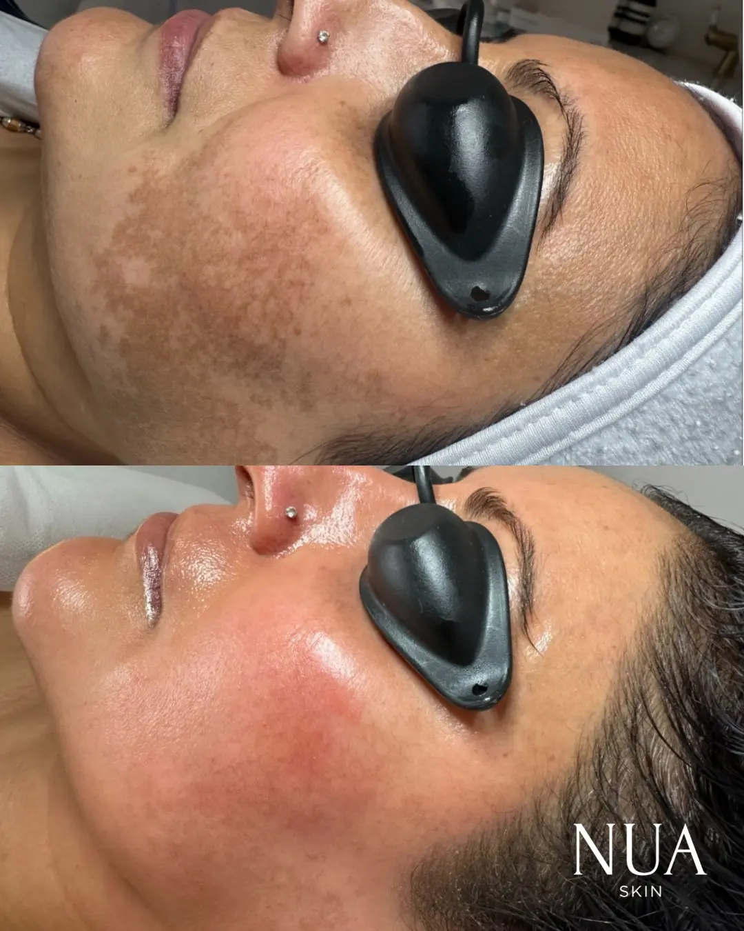 Before and after skin treatment — Melasma Faded