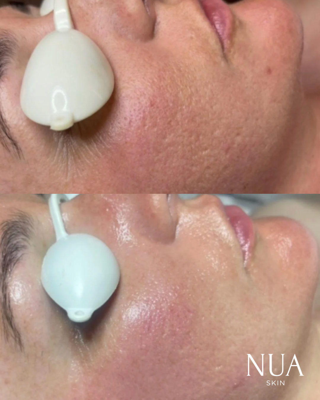 Before and after skin treatment — Even Skin Tone Restored