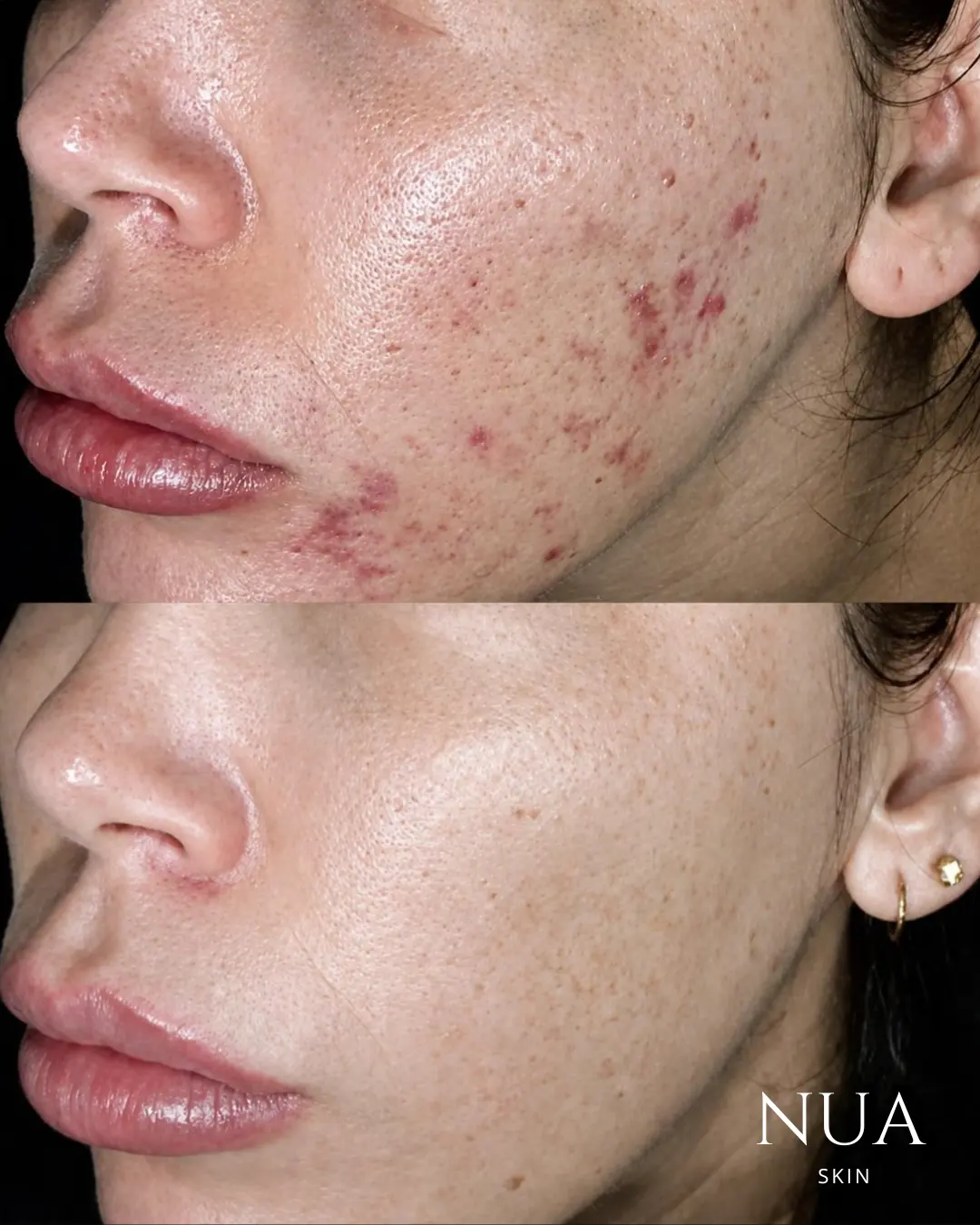 Before and after skin treatment — Post-Acne Marks Faded