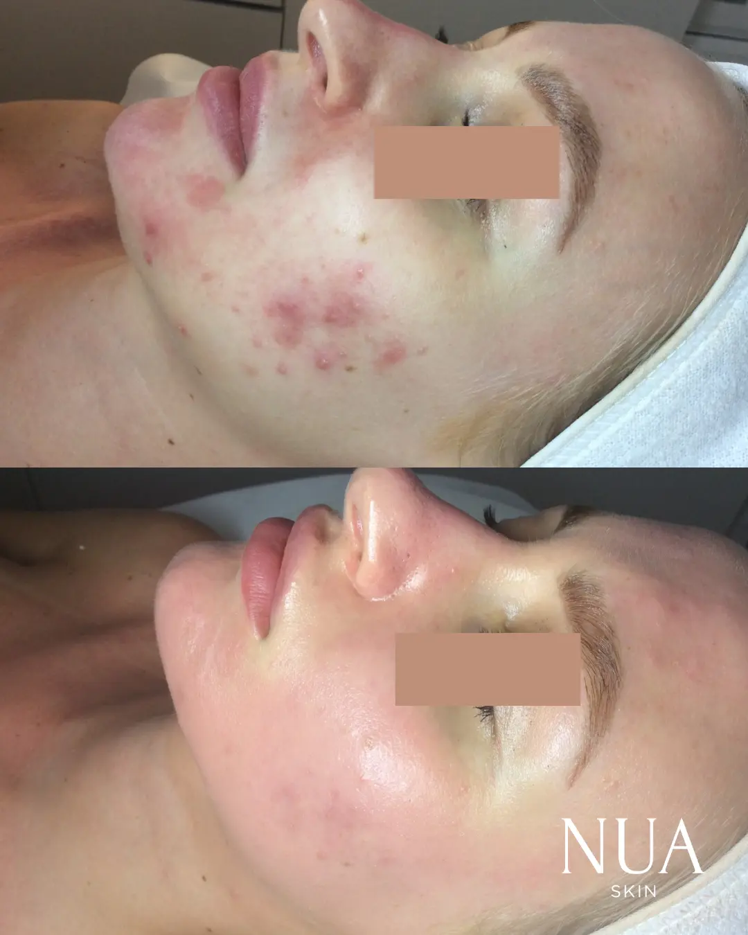 Before and after skin treatment — Redness & Pigment Calmed